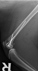 Distale Femurepiphysiolyse Katze nach Versorgung mit Bohrdrähten