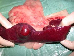 Tumor in Milz